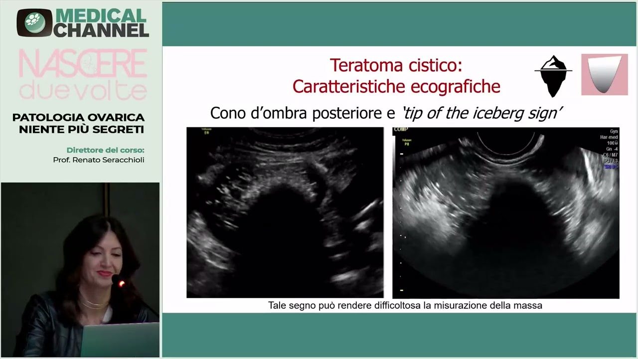 Teratomi cistici, struma ovarii, fibromi fibrotecomi ovarici, tumore di Brenner - S. Del Forno
