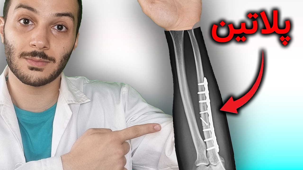 با پلاتین استخوان چه کنیم؟ باید و نباید های خارج سازی پلاتین