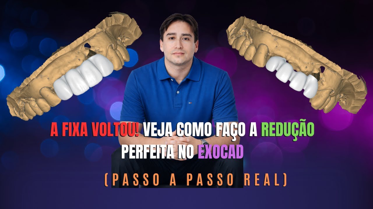 A Fixa Voltou! Veja Como Faço a Redução Perfeita no Exocad (Passo a Passo REAL)