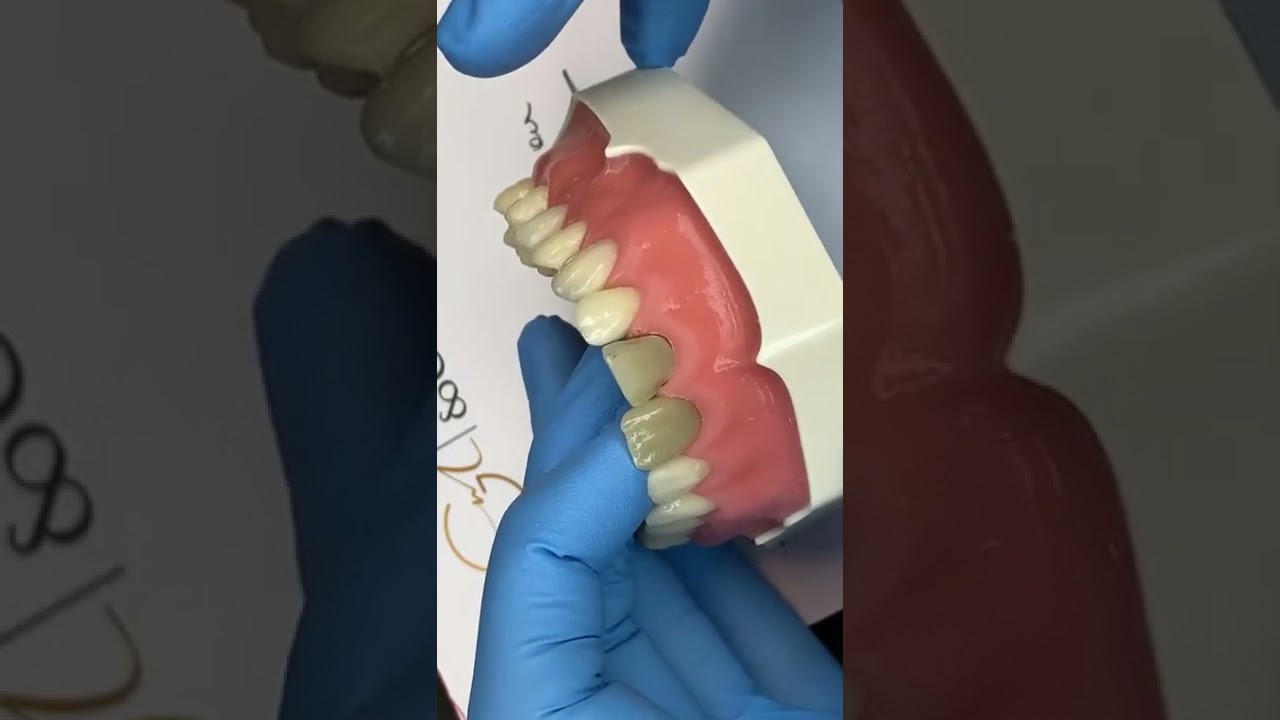 Super Live 4 - Dentes Escurecidos Facetas em Resina