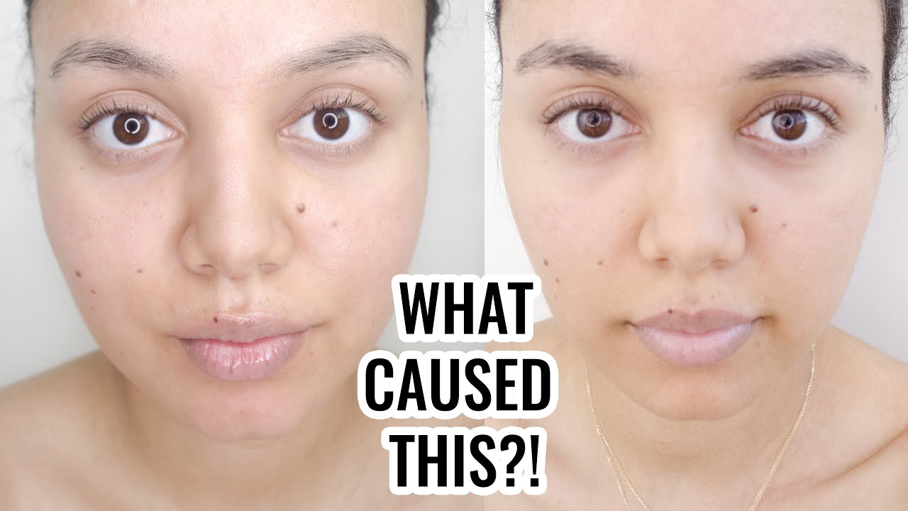 My Eyebrows Fell OUT Last Summer STORY TIME