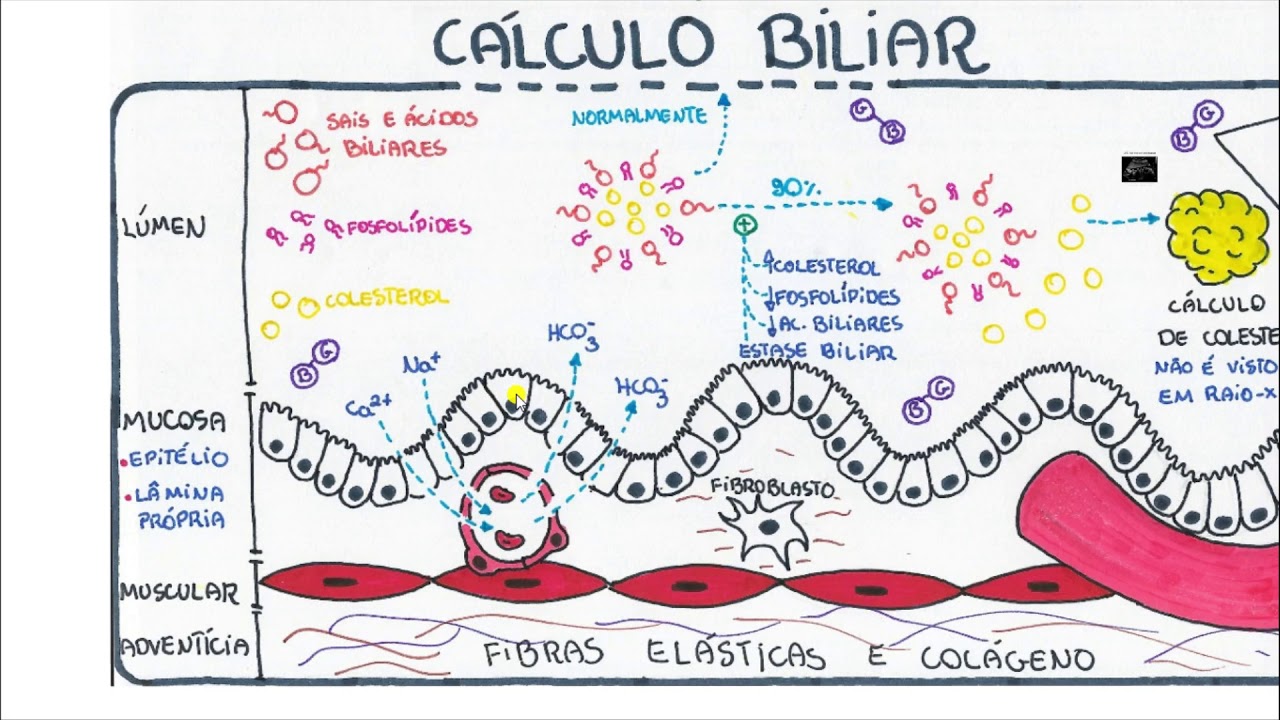 Vias biliares, Bile e Colelitíase ( Epidemiologia, patologia, diagnóstico)