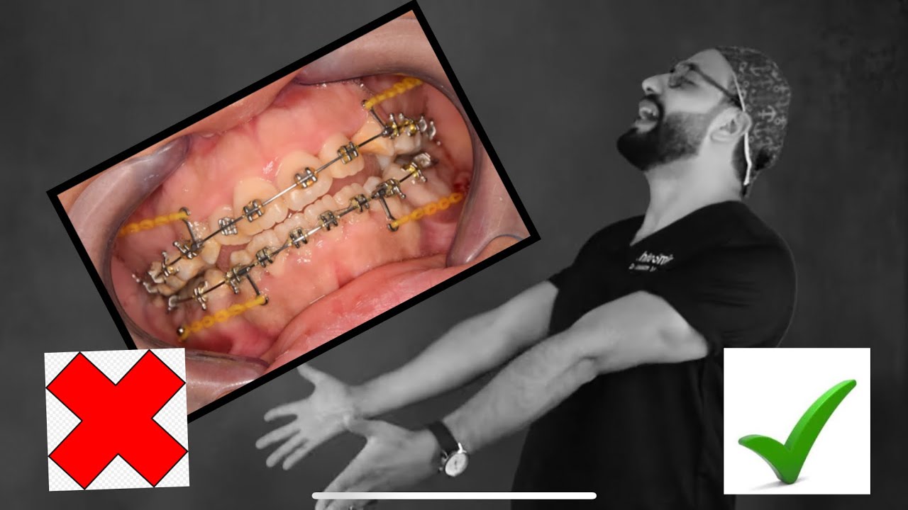 اكتشف بنفسك هل تحتاج الي تقويم اسنان ام لا ؟ و ما هي مشاكل الاسنان التي تحل بالتقويم ؟