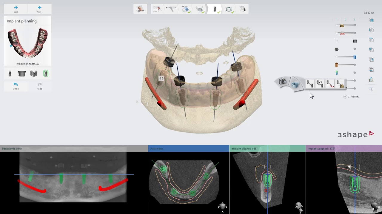 3Shape Implant Studio - Caso de Edentados - Como realizar o planejamento de implante