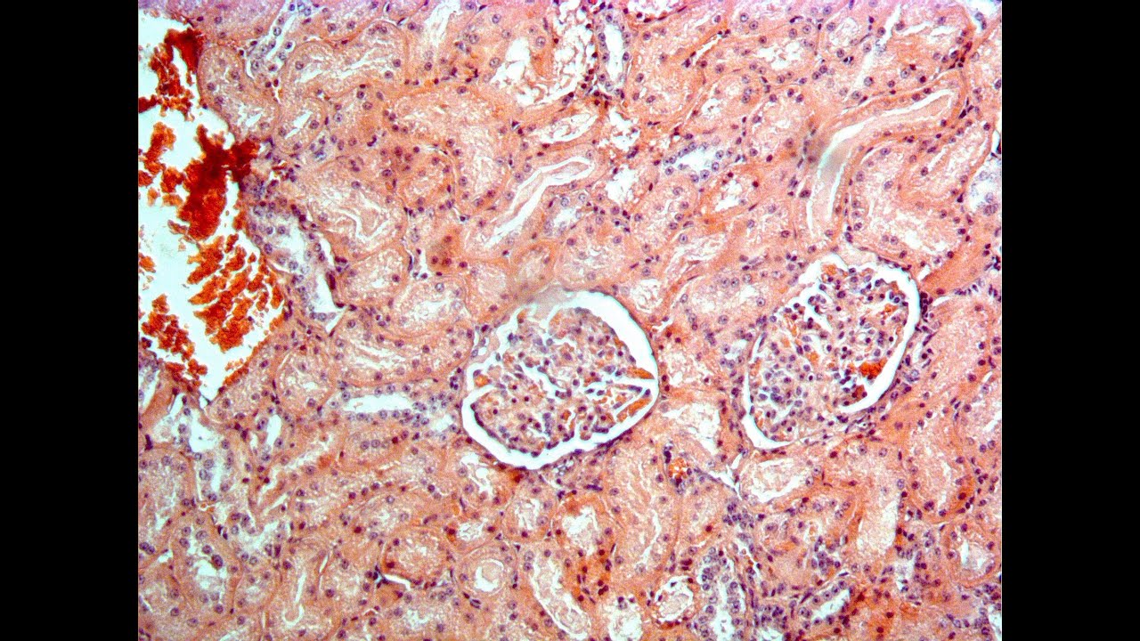 Amiloidosis sistémica AA: un problema potencial de salud pública