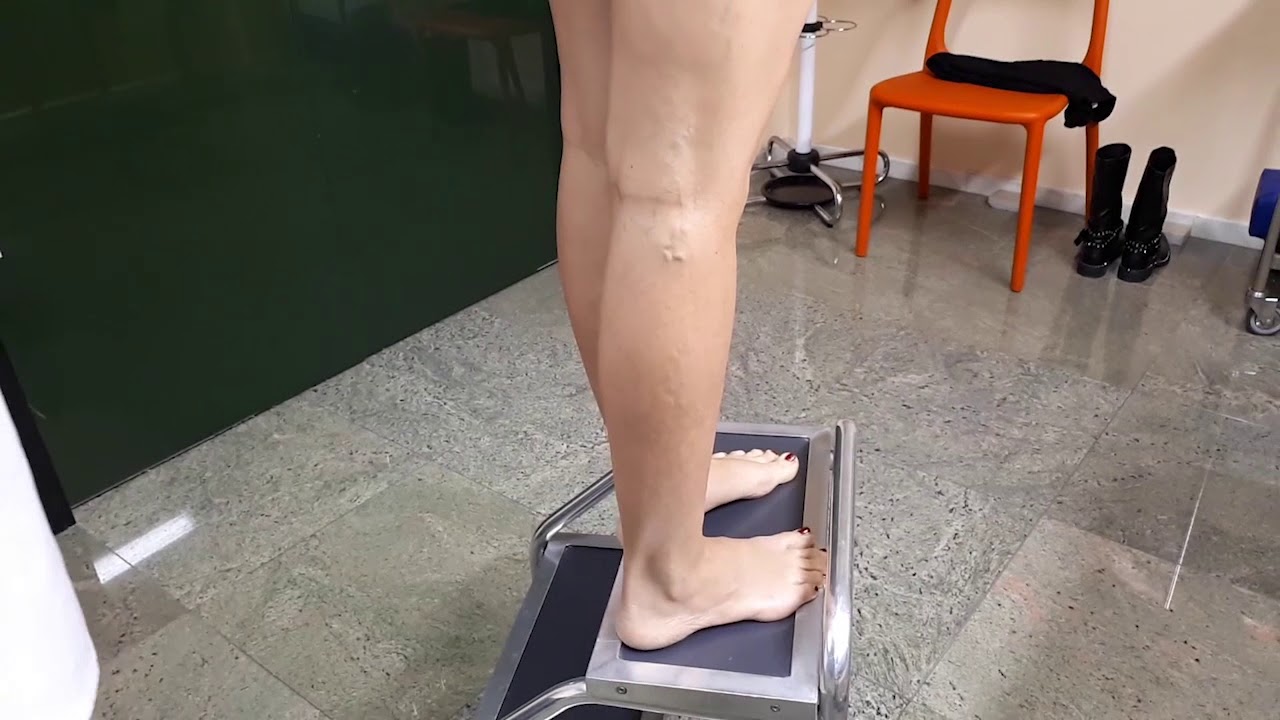 HO DELLE VENE VARICOSE