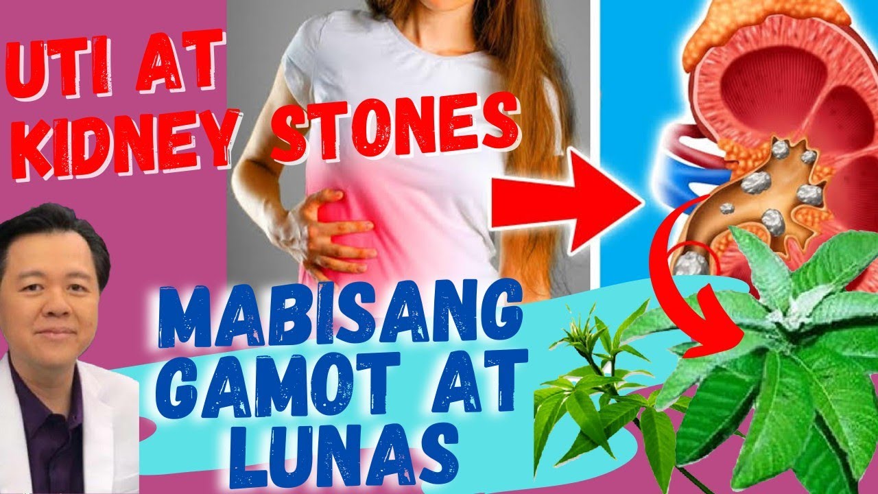 Kidney Stones at UTI: Mabisang Gamot at Lunas - Payo ni Doc Willie Ong