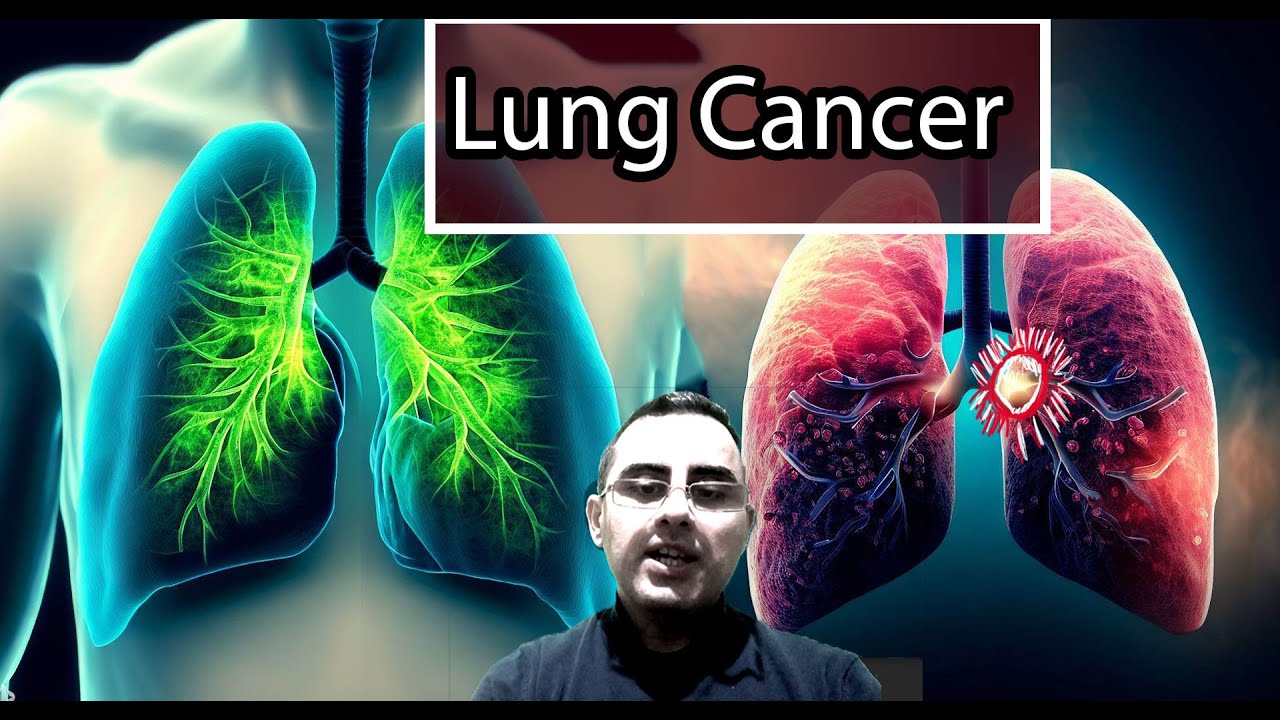Lung Cancer: From the Deadliest to the Least Aggressive Forms