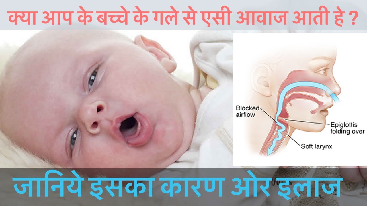 क्यों आती हे बच्चे के गले से कफ जेसी आवाज | नही ठीक होगी दवाई से | इस का इलाज | laryngomalacia