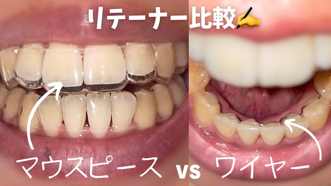 リテーナーのメリット&デメリットについて