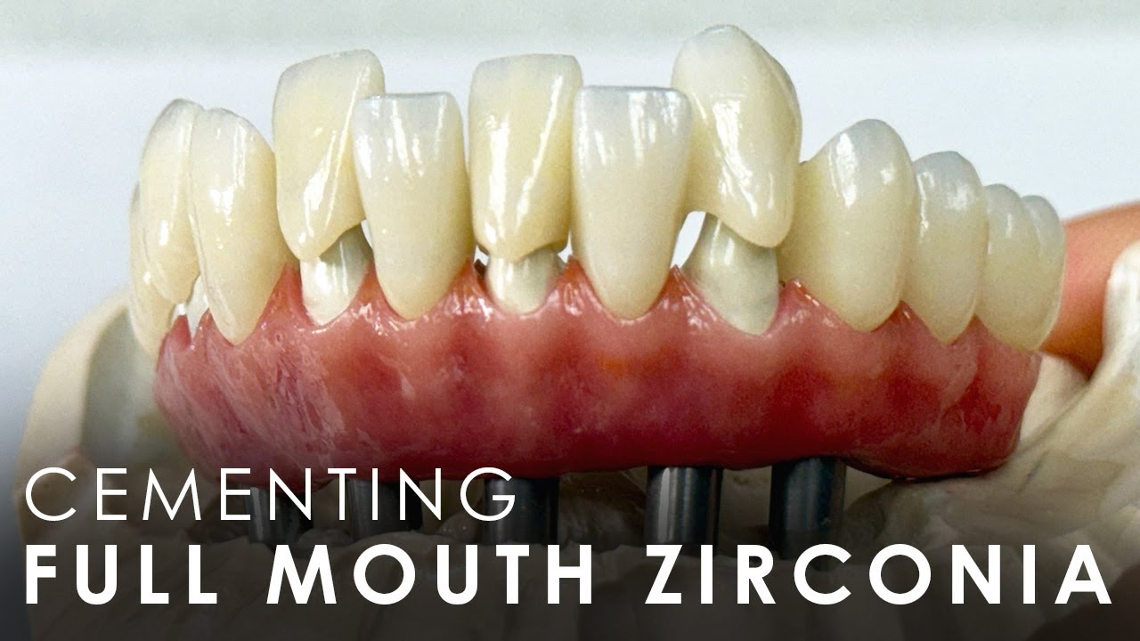 Cementing a Lower Syton 7-Star Zirconia Arch