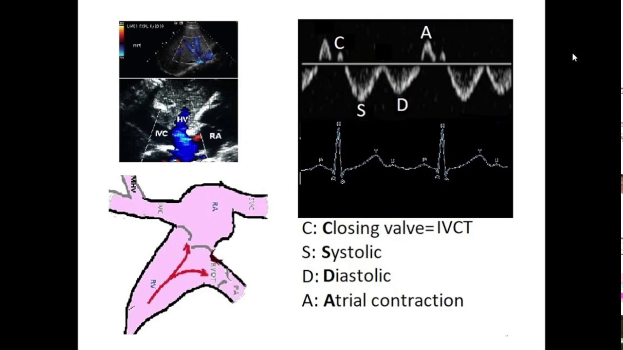 Answer to question 15 -hepatic vein Doppler interpretation