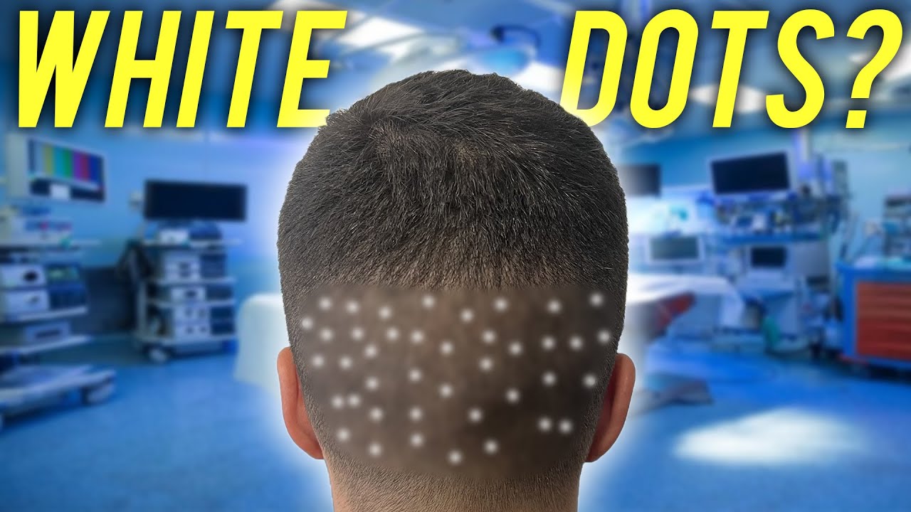 IL QUINTO MESE DOPO IL TRAPIANTO DI CAPELLI
