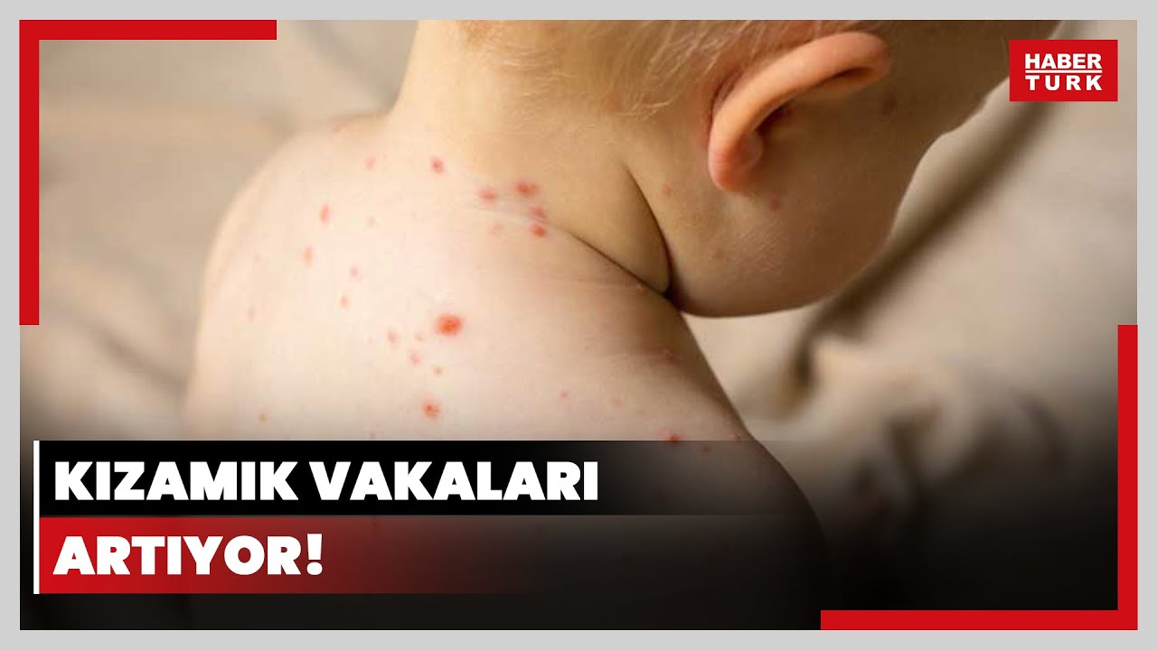 Kızamık vakaları artıyor