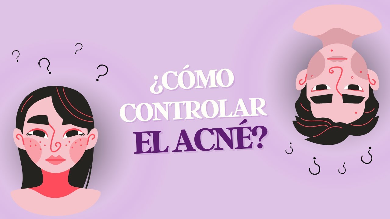 TIPS PARA CONTROLAR EL ACNÉ