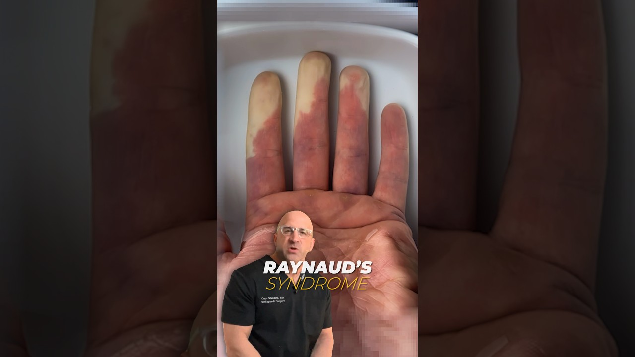 More Than Just Pale Fingers and Toes - Raynaud&rsquo;s Syndrome #shorts
