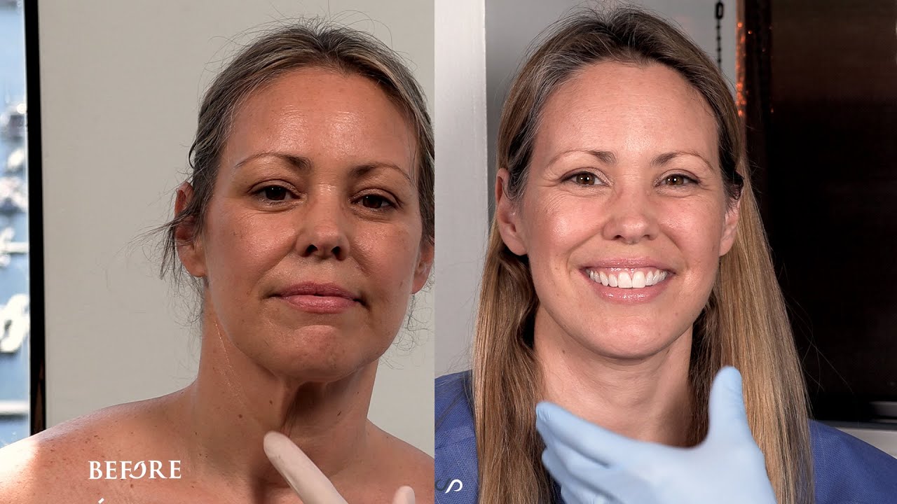 Traceless Facelift, Upper Eye Lid Lift and Neck Lift  | Dr. David Stoker