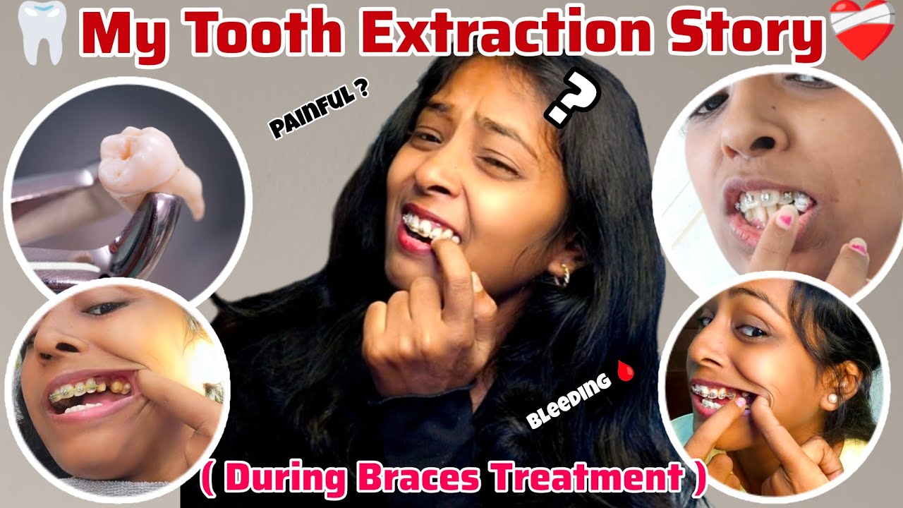 😰❤️‍🩹🦷 Scary Story of Tooth Extractions During Braces || 5 दांत उखड़वाए 🤢Watch this Before Treatment