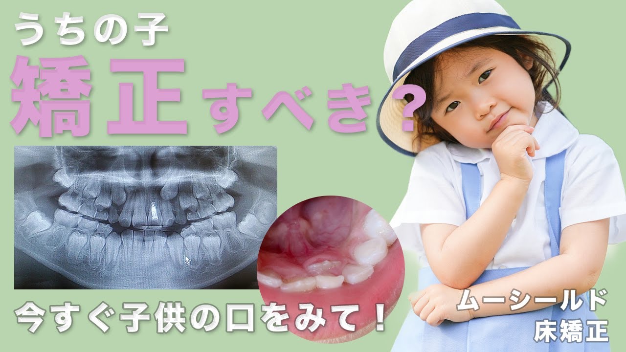 【小児矯正・前編】子供の歯並び早く治療が必要なのは？子供しかできない治療法とは？先生が解説します！【Ⅰ期治療】