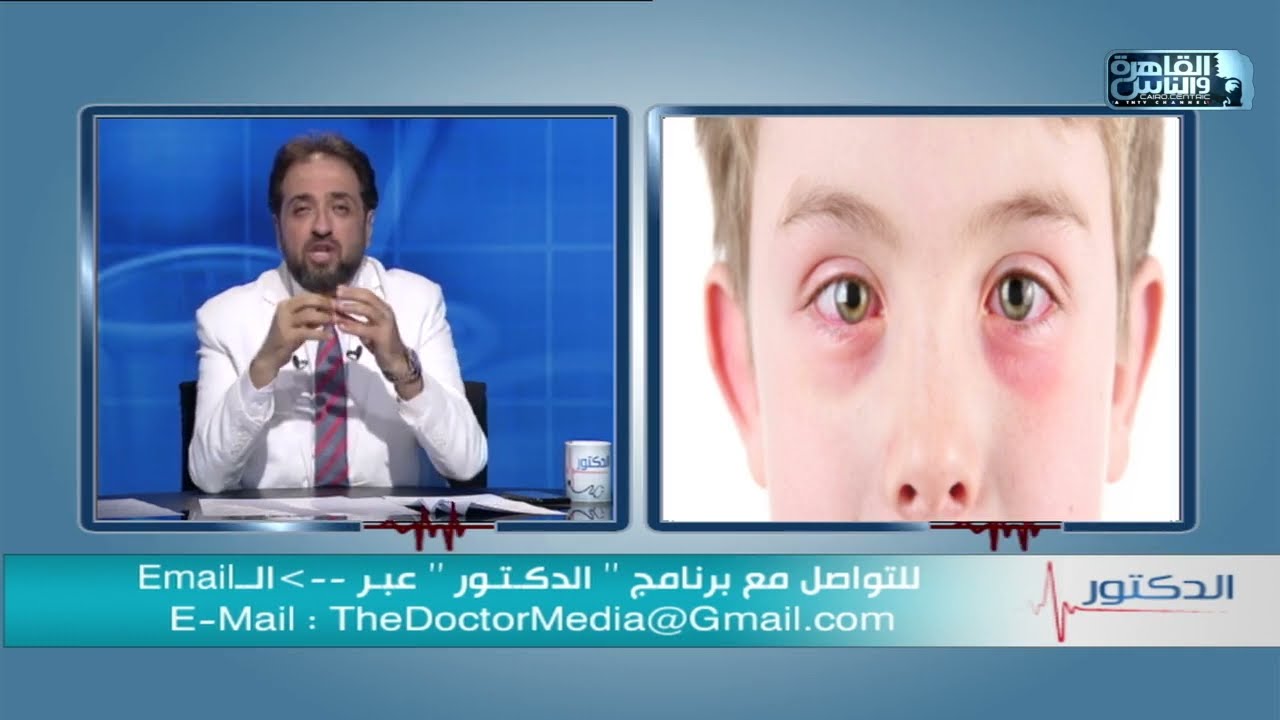 الدكتور | اسباب احمرار العين عند الأطفال وطرق العلاج مع دكتور اسامة عبد الحكيم
