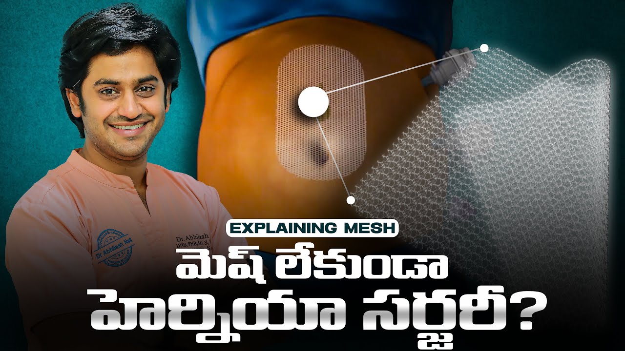 Can Hernia Surgery Be Done Without Mesh? | Dr. Abhilash Explains