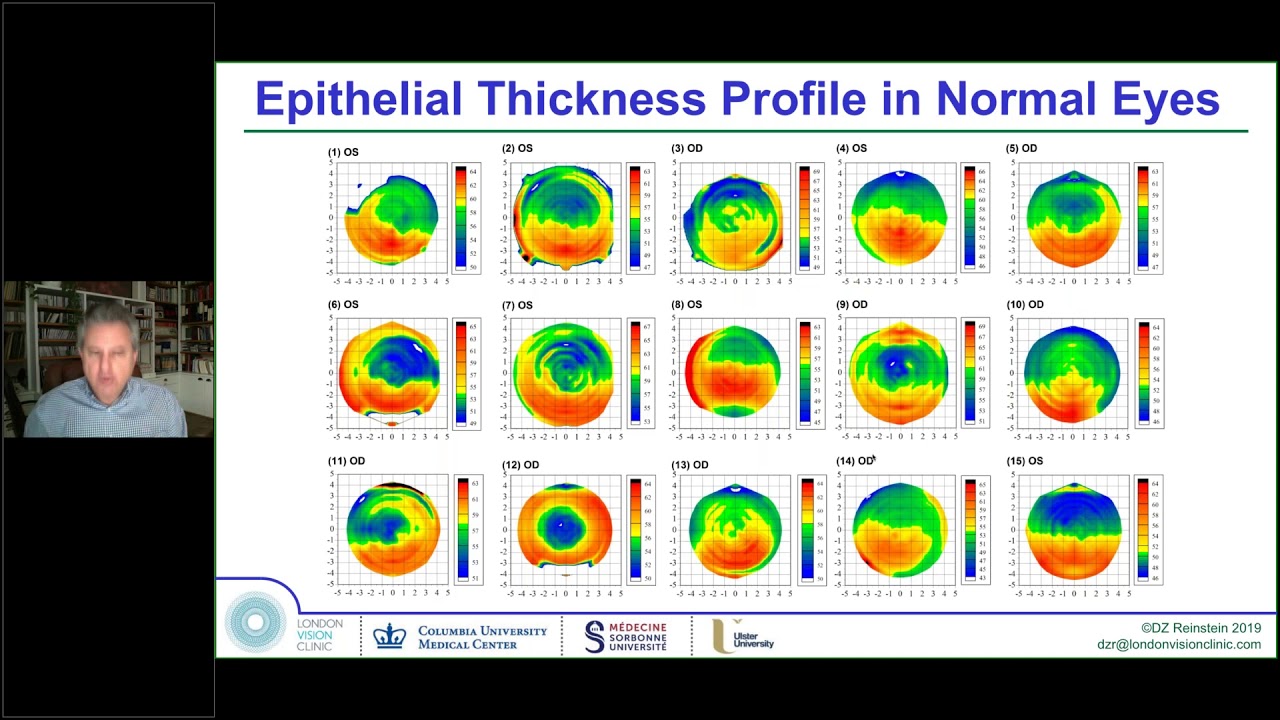 LIVE Webinar  Decision Making Matrix – SMILE vs LASIK vs PRK vs TransPRK vs ICL