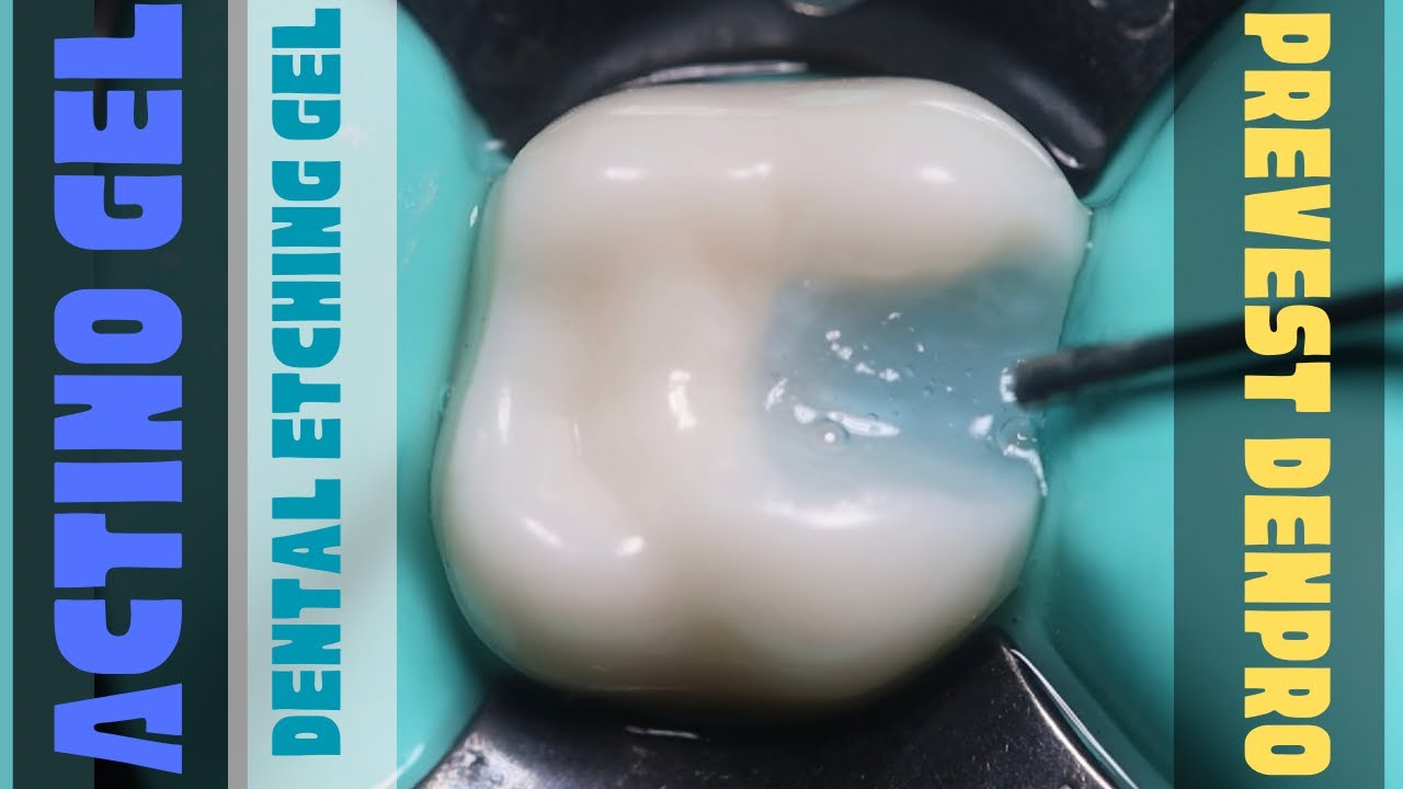 Actino Gel || Dental Etching Gel || Demonstration in Primary Molar