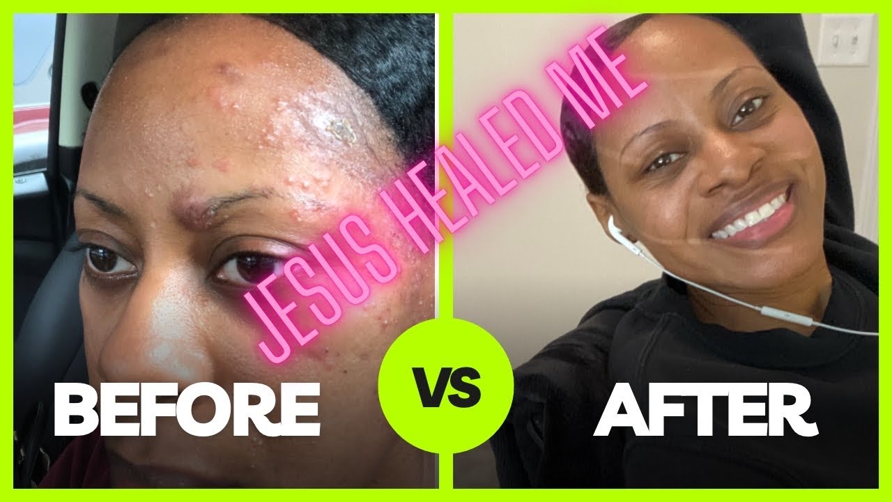Jesus Healed My Face | My Testimony