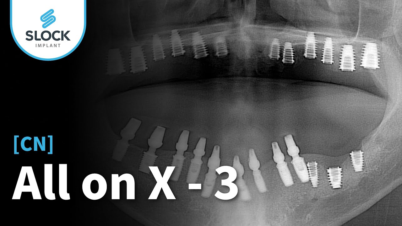 [CN] AllonX - 3