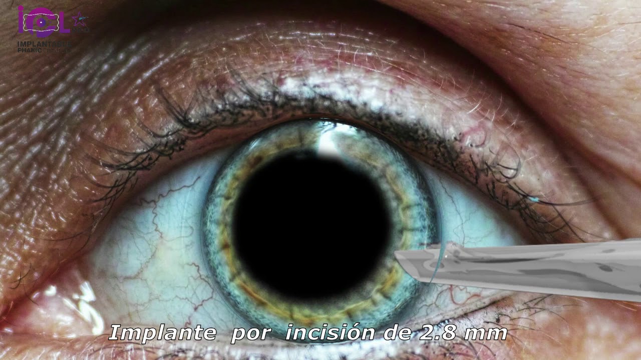 Lente Intraocular hidrof&iacute;lica IPCL