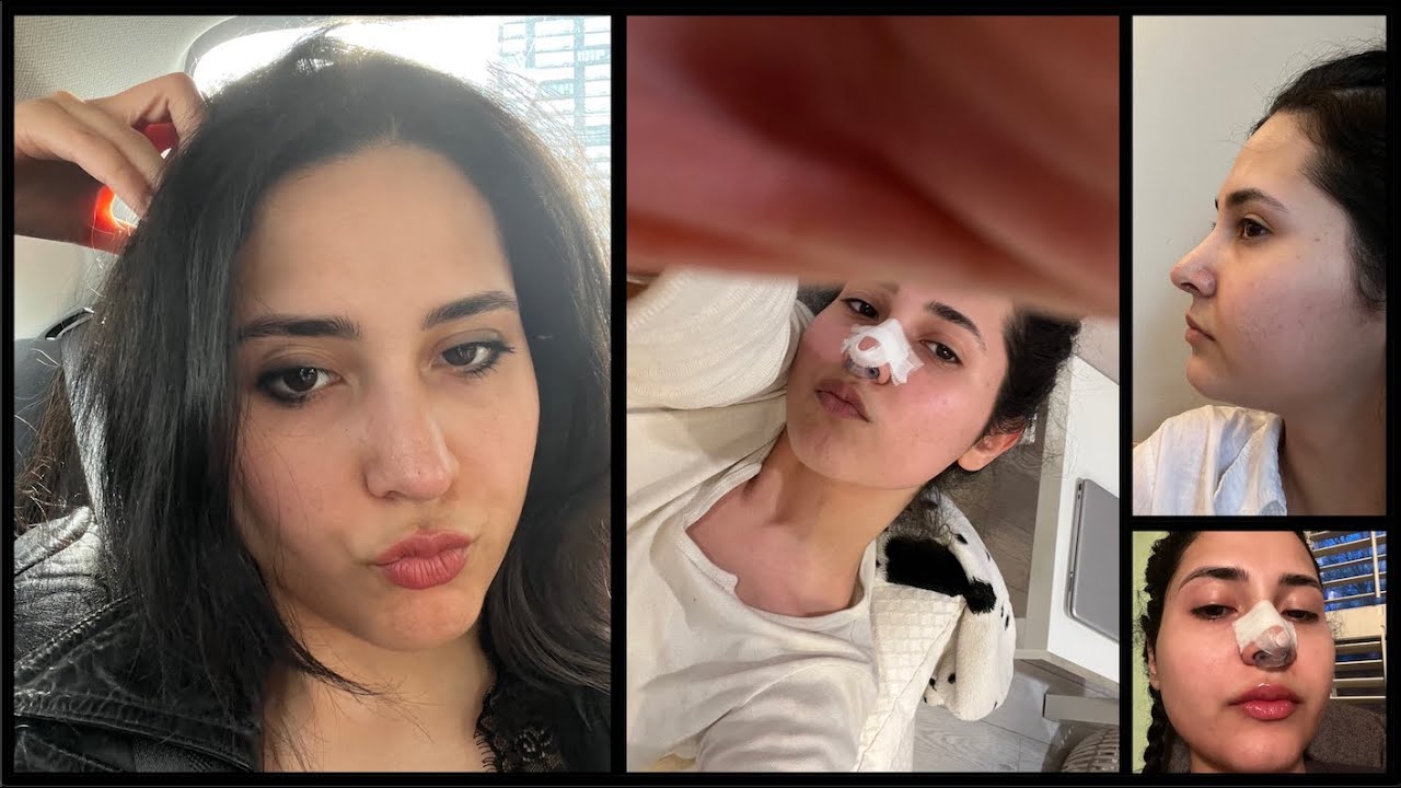 1 MONTH POST OP RHINOPLASTY IN ISTANBUL, TURKEY | THINGS I REGRET AND THINGS I DON'T