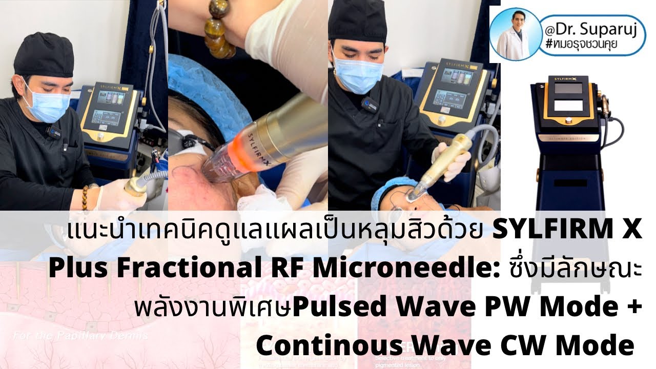 รักษาแผลหลุมสิวด้วย SYLFIRM X Plus Fractional RF Microneedle Pulsed Wave PW+Continous Wave CW Mode