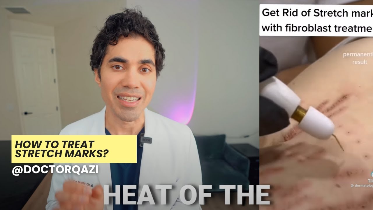 How To Treat Stretch Marks