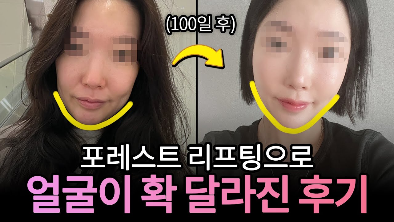 포레스트 리프팅으로 얼굴이 확 달라진 후기