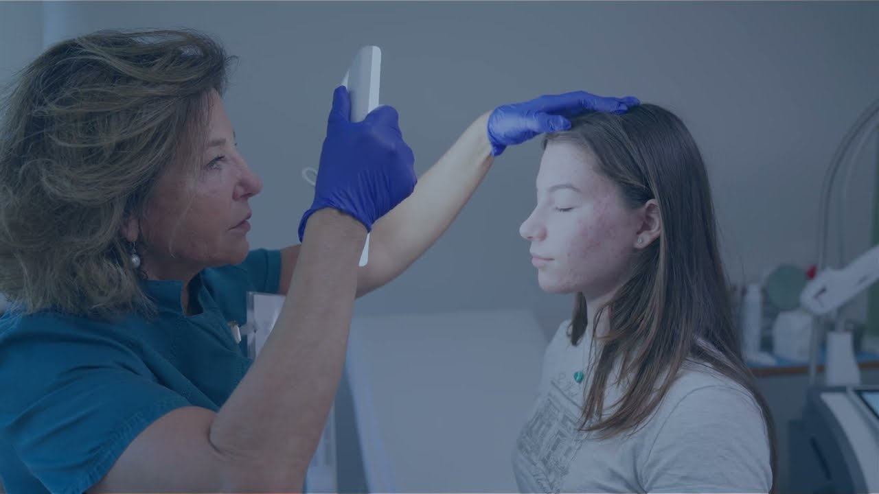 Nuova Speranza per l'Acne: Trattamento Laser Efficace