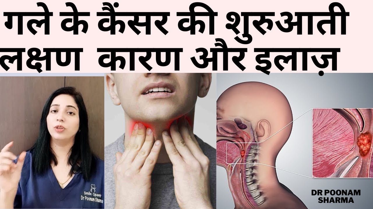 गले के कैंसर के शुरुआती लक्षण करण और इलाज | Initial Symptoms And Treatment Of Throat Cancer