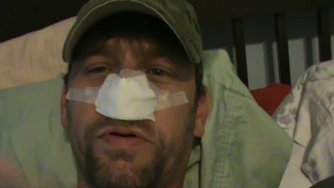 Sinus Surgery Journal Days 1- 4