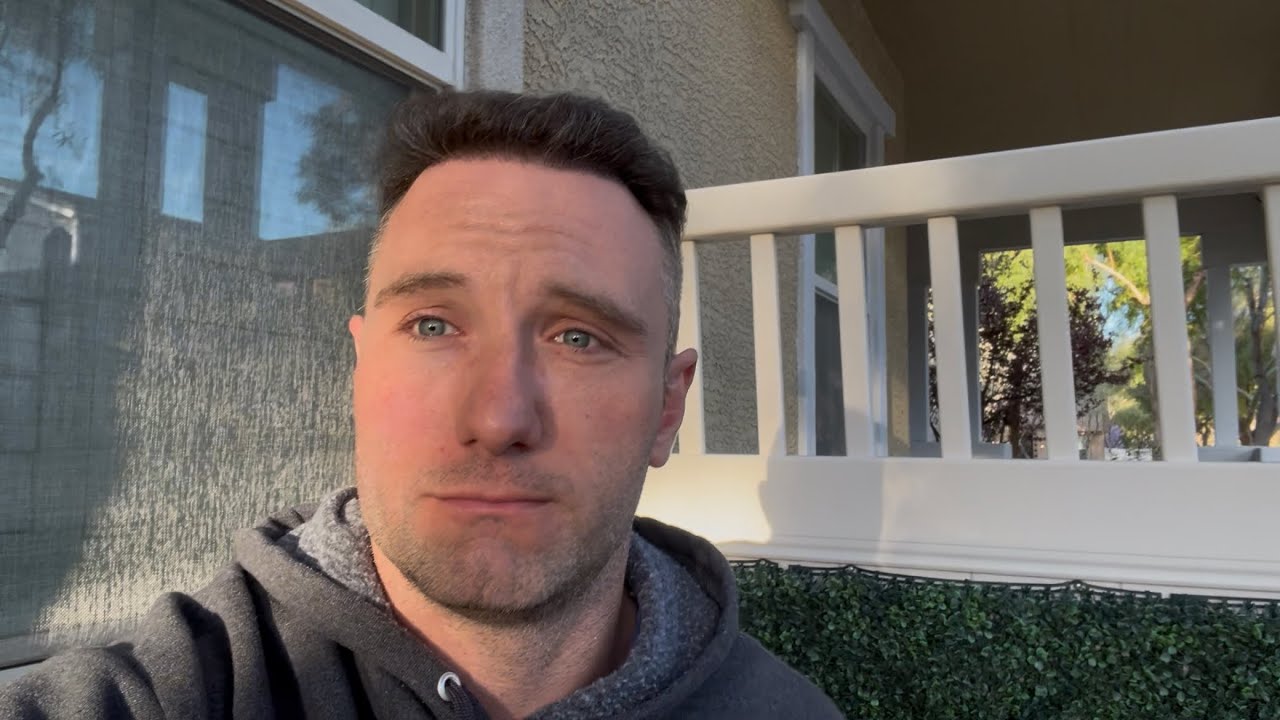 Six Months Post Op Hair Transplant At HMR Tijuana 2,900 FUE Grafts