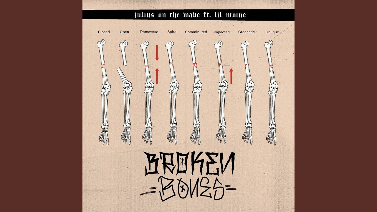 BROKEN BONES