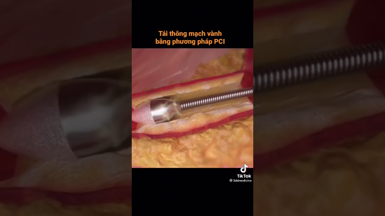 T&aacute;i th&ocirc;ng mạch v&agrave;nh bằng PCI - percutaneous coronary intervention