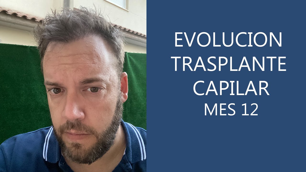 Evolución Trasplante capilar en Turquía - 12 meses