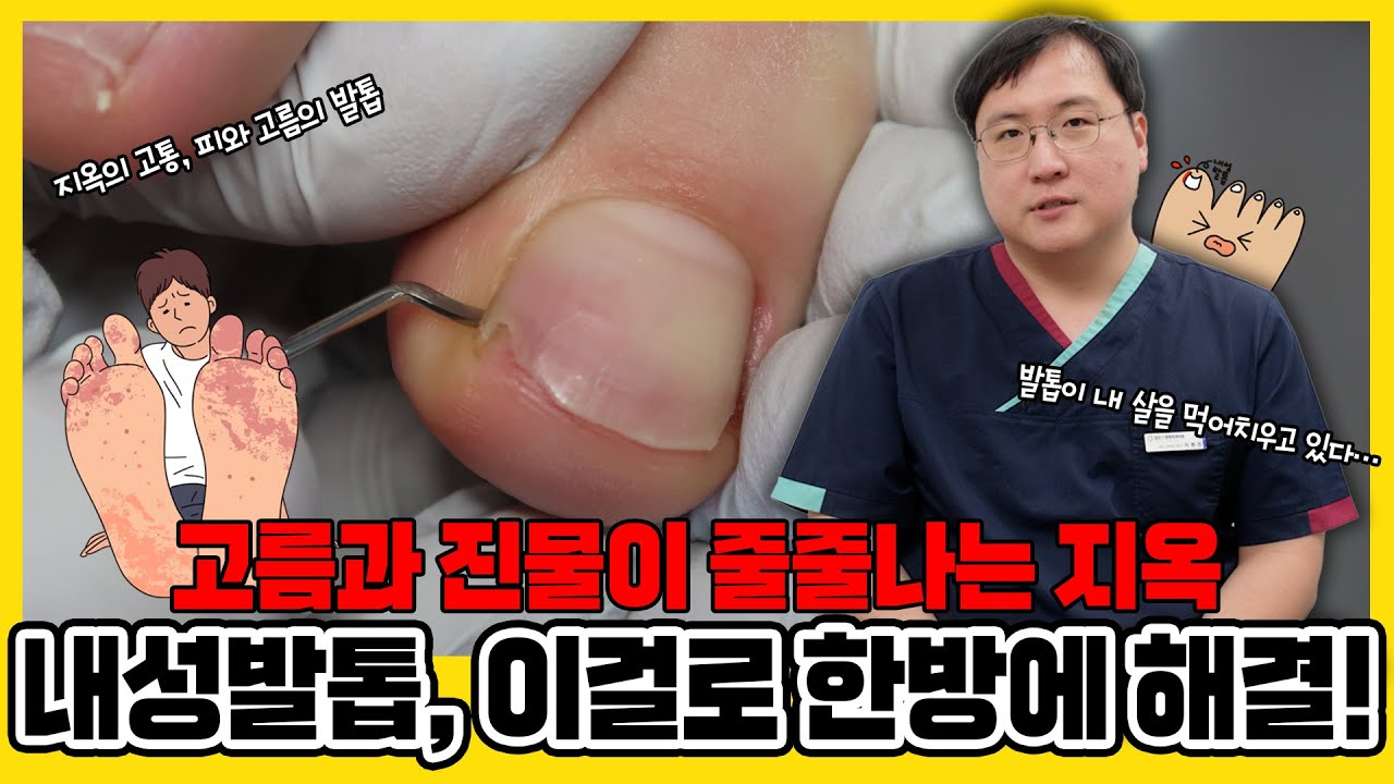 내성발톱, 단순히 아픈 것만이 아닙니다!!