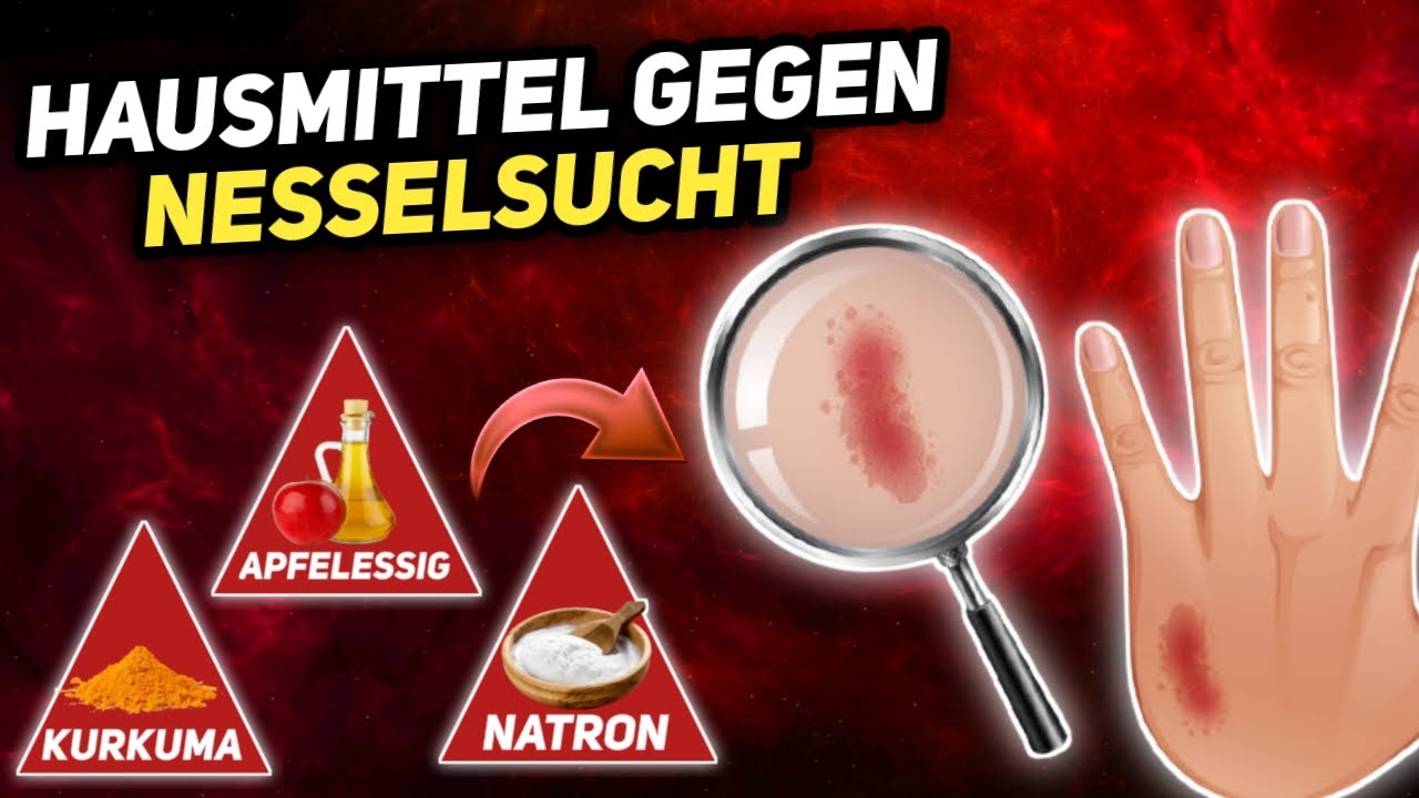 10 Natürliche Hausmittel gegen Nesselsucht