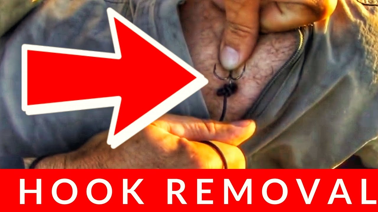 Best Hook Removal Technique | ANGLER HOOKS HIMSELF