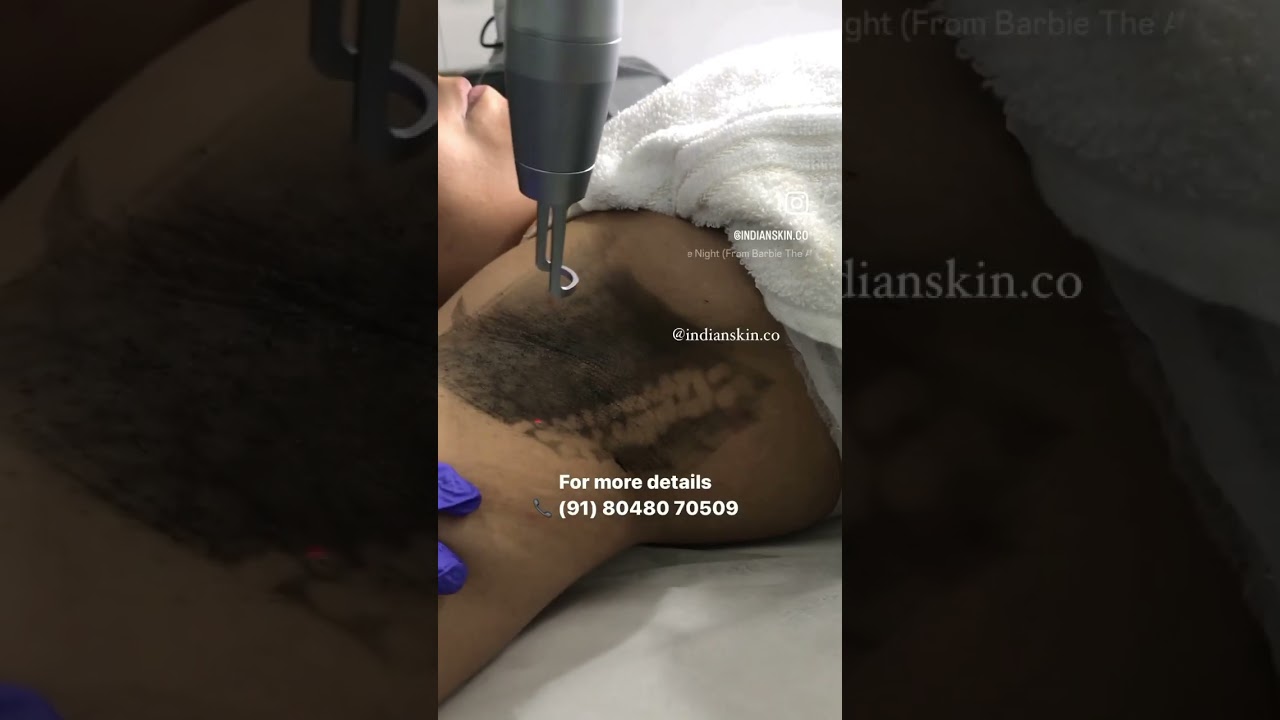 Dark Underarms treatment | Laser treatment | Nagpur #drayeshafaizan #skinclinicnearme  #indianskin