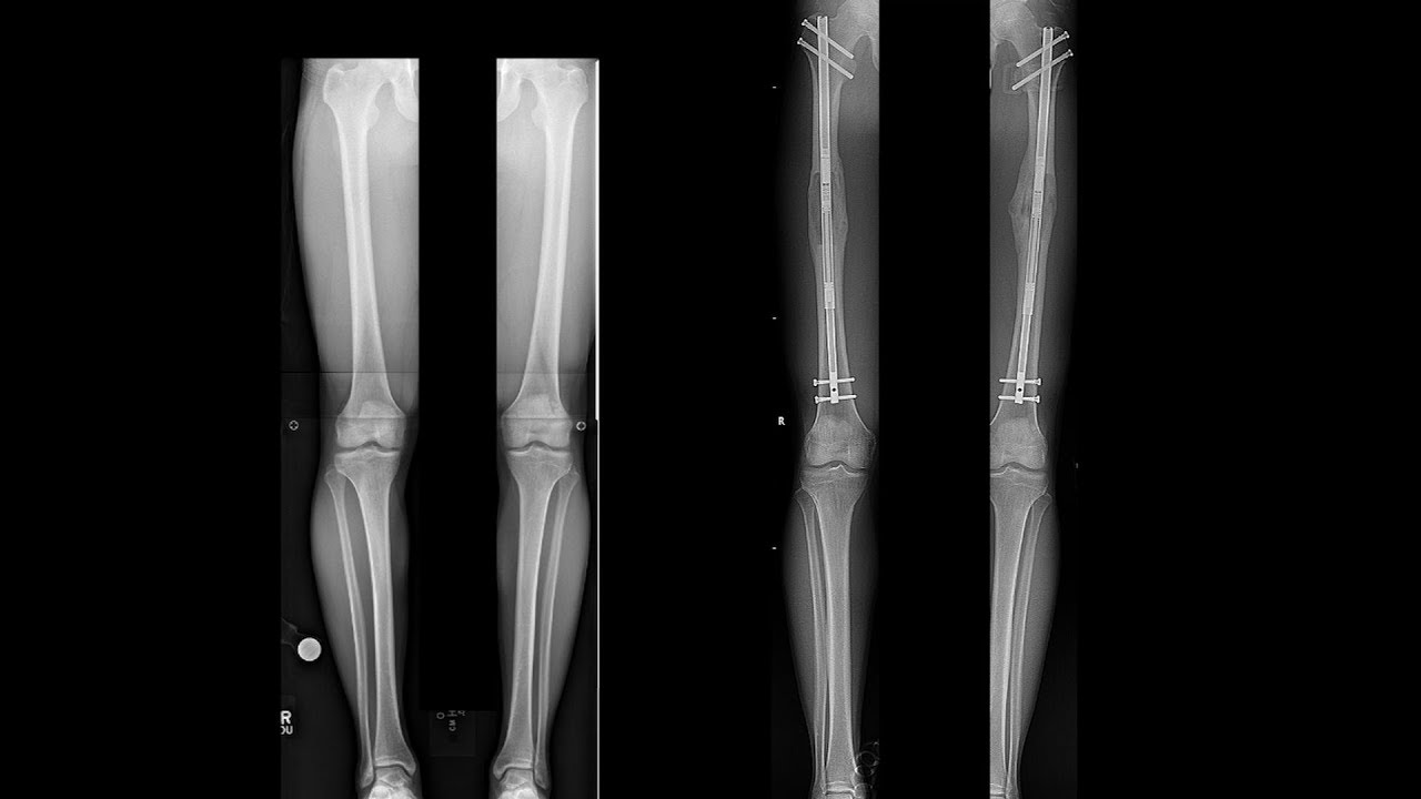 Dr. S. Robert Rozbruch - A STATURE LENGTHENING Profile