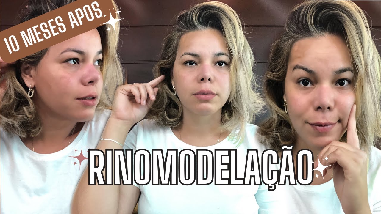 RINOMODELAÇÃO RESULTADO 10 MESES APÓS A CIRURGIA 