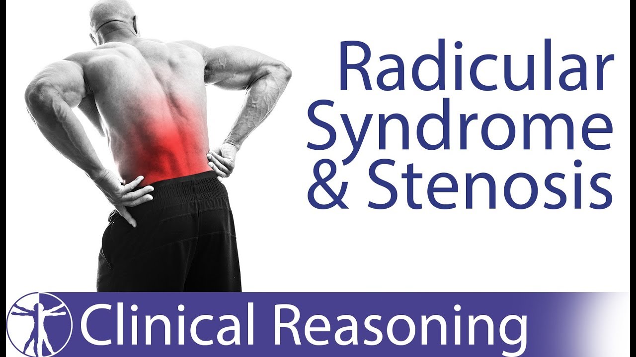 Lumbar Radicular Syndrome vs. Intermittent Neurogenic Claudication/Stenosis