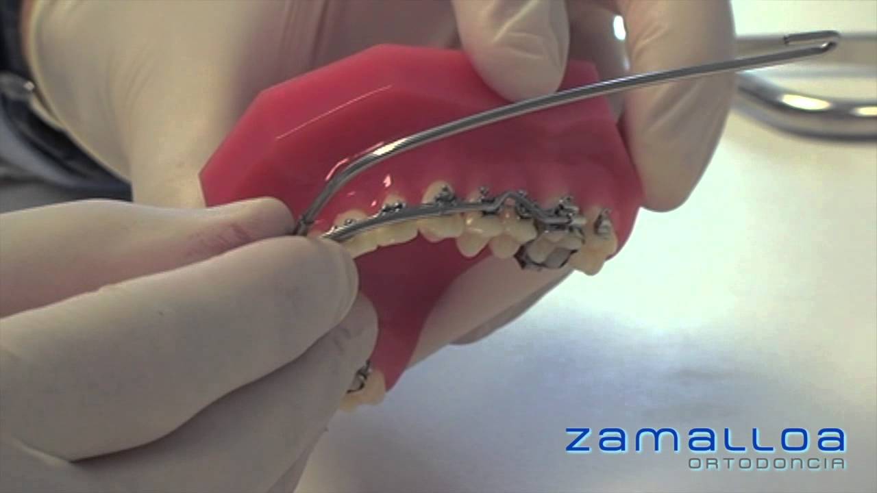 Aparato de anclaje extraoral en ortodoncia  | Ortodoncia Zamalloa