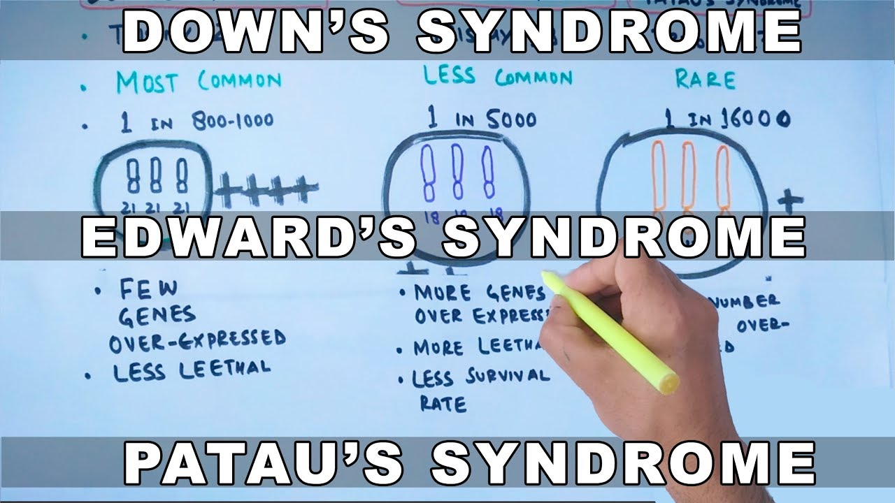 Трисомия | Синдром Дауна, Эдвардса и Патау